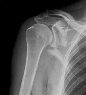 Glenoid Scapular Fracture